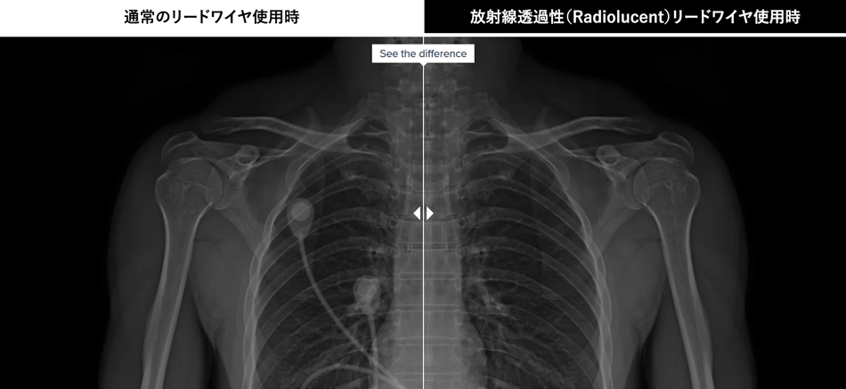 放射線透過性（Radiolucent）リードワイヤ